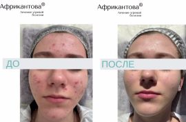 История преображения: 15-летняя Мария и ее победа над хроническим АКНЕ!