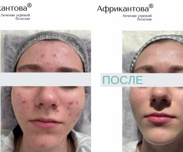 История преображения: 15-летняя Мария и ее победа над хроническим АКНЕ!