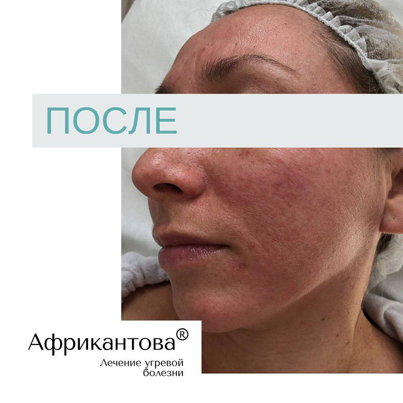 лечение розацеа до и после