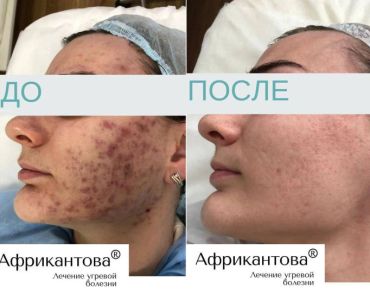 Лечение акне по запатентованной технологии