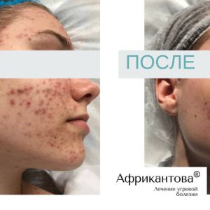 Лечение акне до и после