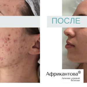 Лечение акне до и после