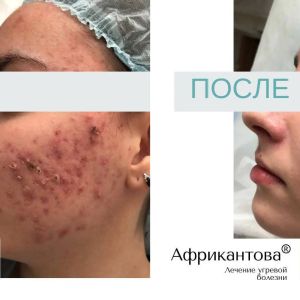 Лечение акне до и после