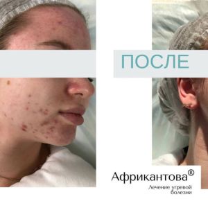 Лечение акне до и после